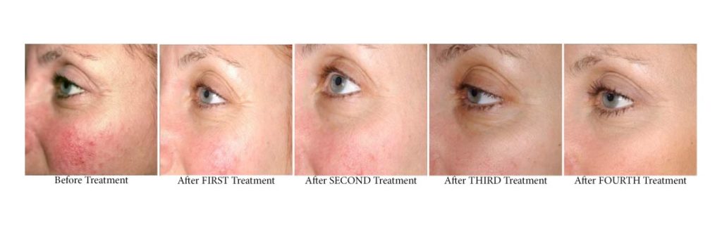 Face Tightening Rejuvenation Bella Alpharetta Buckhead