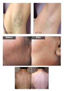 laser hair removal- before and after