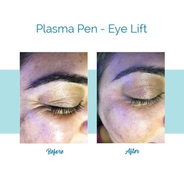 Plasma Pen - Eye Lift