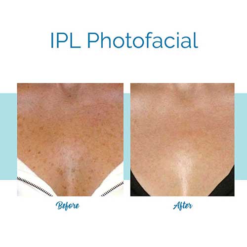 IPL Photofacial- Chest