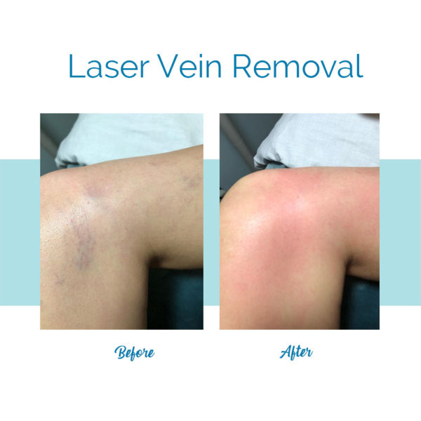 Laser Vein Removal - Legs
