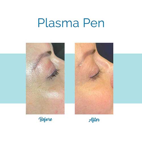 Plasma Pen - Before & after