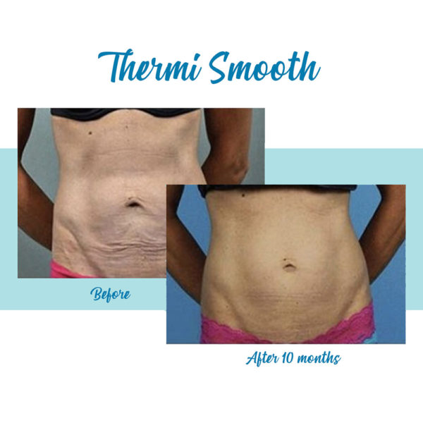 ThermiSmooth body contouring and skin tightening treatments are offered by Bella Medspa in Buckhead and Alpharetta