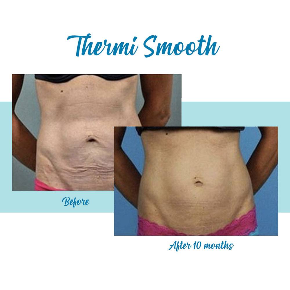 ThermiSmooth body contouring and skin tightening treatments are offered by Bella Medspa in Buckhead and Alpharetta