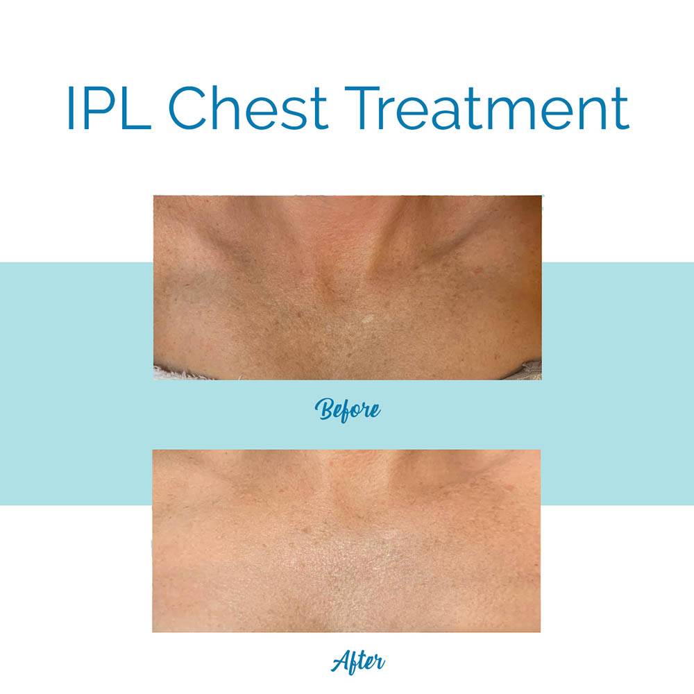 IPL Photofacial- Chest