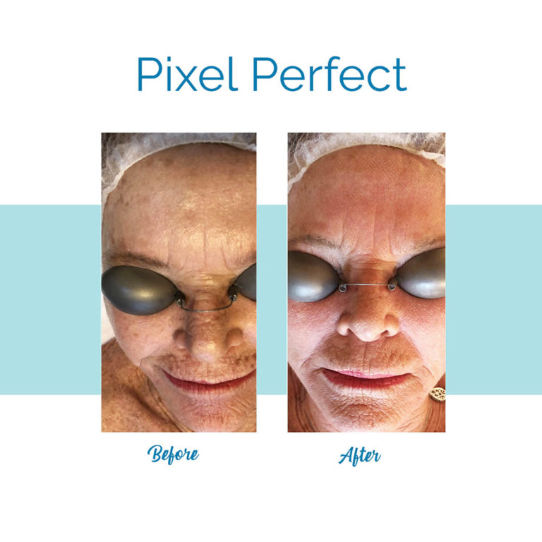 pixel perfect laser before and after