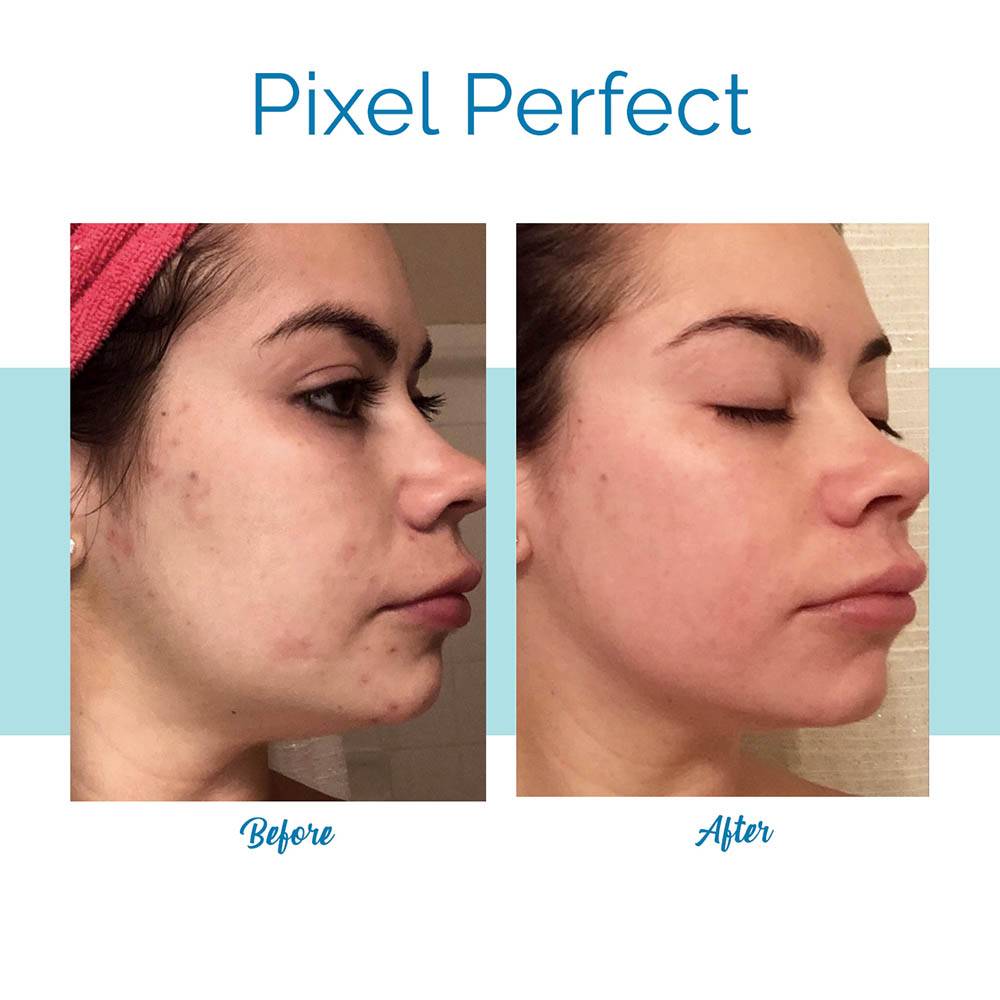 Pixel Perfect Laser Facial - Before & After