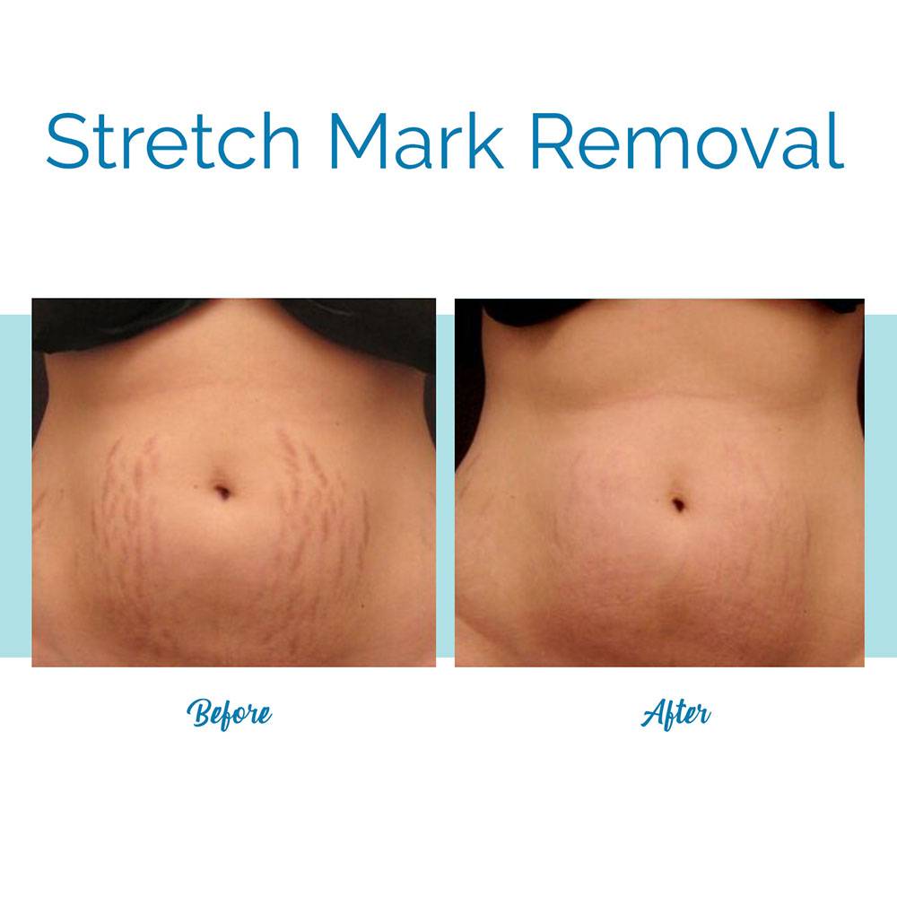 laser stretch mark removal