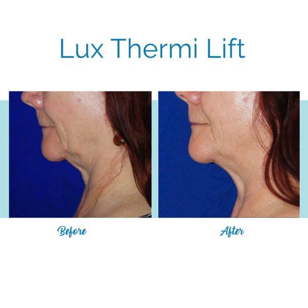 Thermi Lift - Neck - for skin tightening