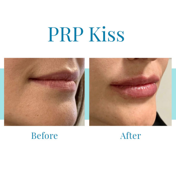 PRP Kiss Therapy