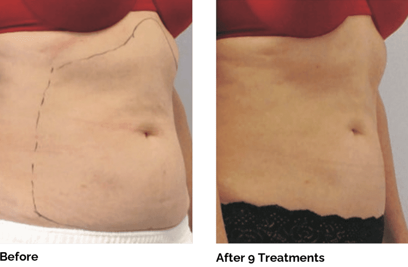 Venus Legacy in Buckhead and Alpharetta reduces fat and tightens the skin in the arms