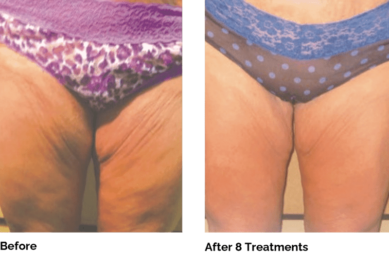 Venus Legacy in Buckhead and Alpharetta reduces fat and tightens the skin in the thighs
