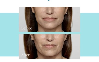 Best Restylane Treatment in Buckhead and Alpharetta