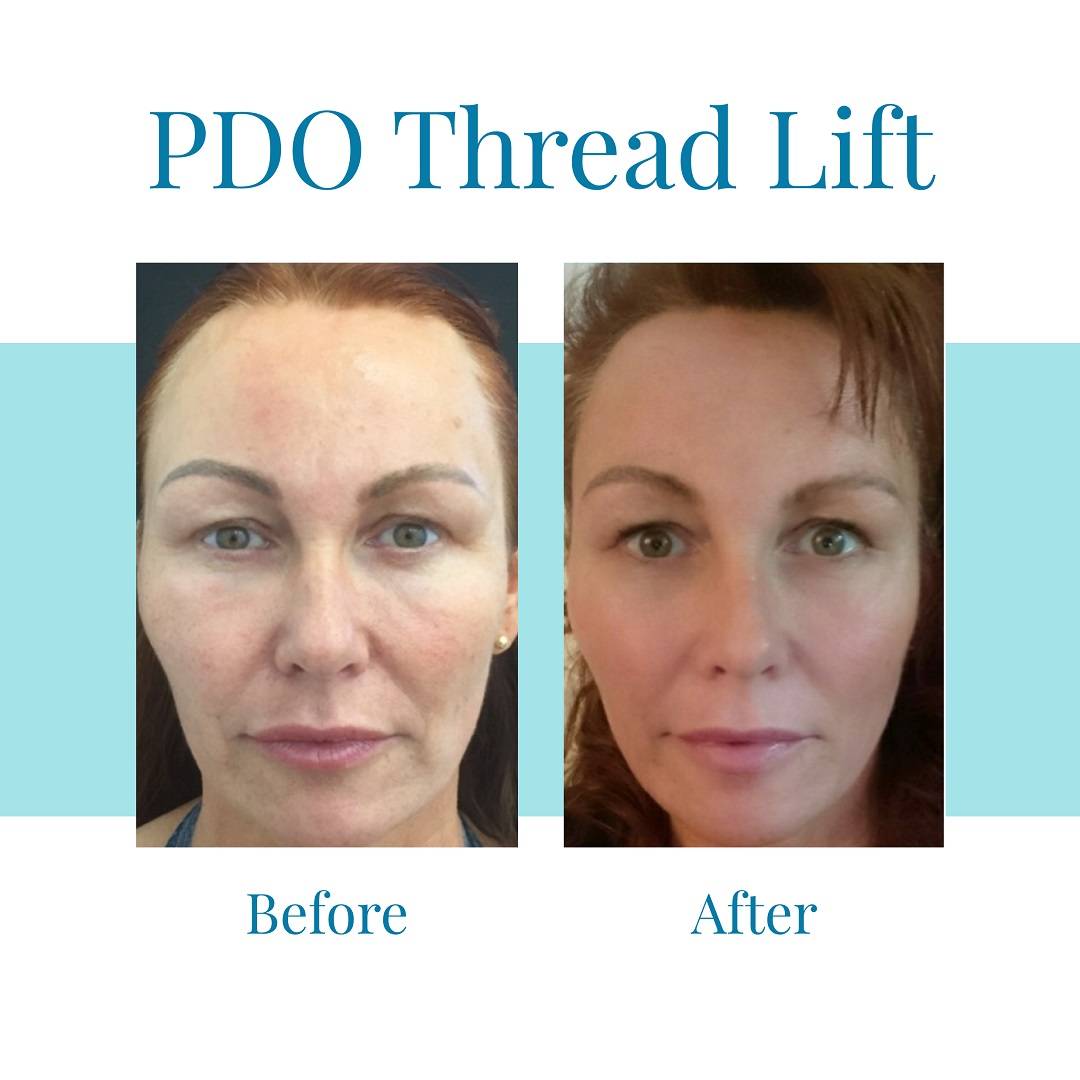 Bella Medspa is the leading provider of PDO Thread Lifts in Buckhead