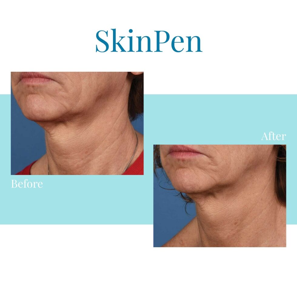Best SkinPen Treatment » Bella Medspa » Buckhead & Alpharetta