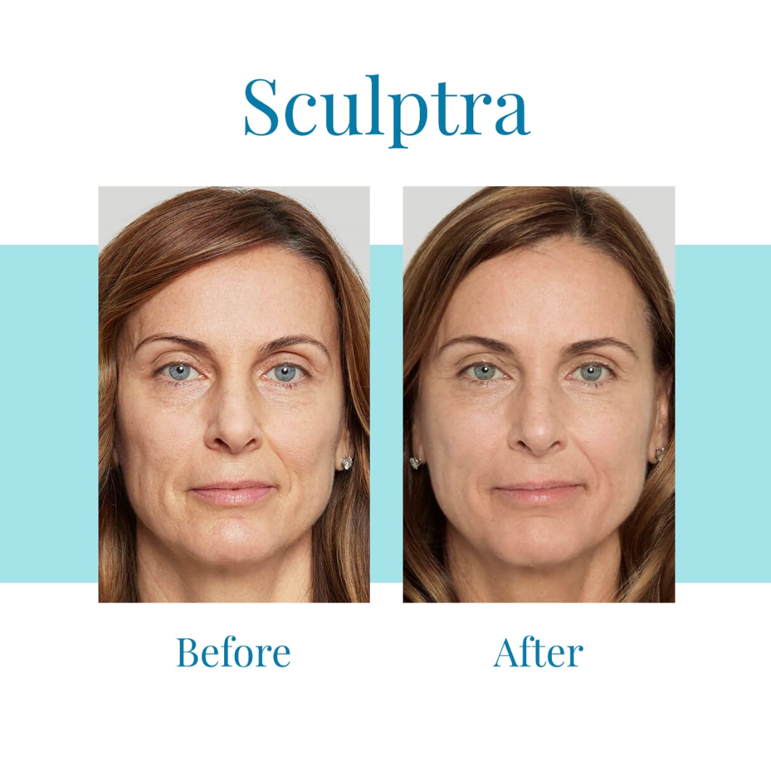 Best Sculptra Treatment » Bella Medspa » Buckhead & Alpharetta