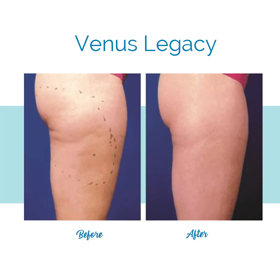 Venus Legacy - Before & After