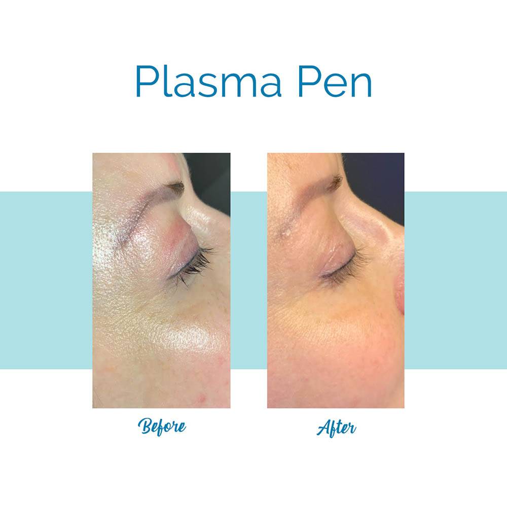 Bella Medspa is the best Plasma Pen provider in Alpharatte and Buckhead