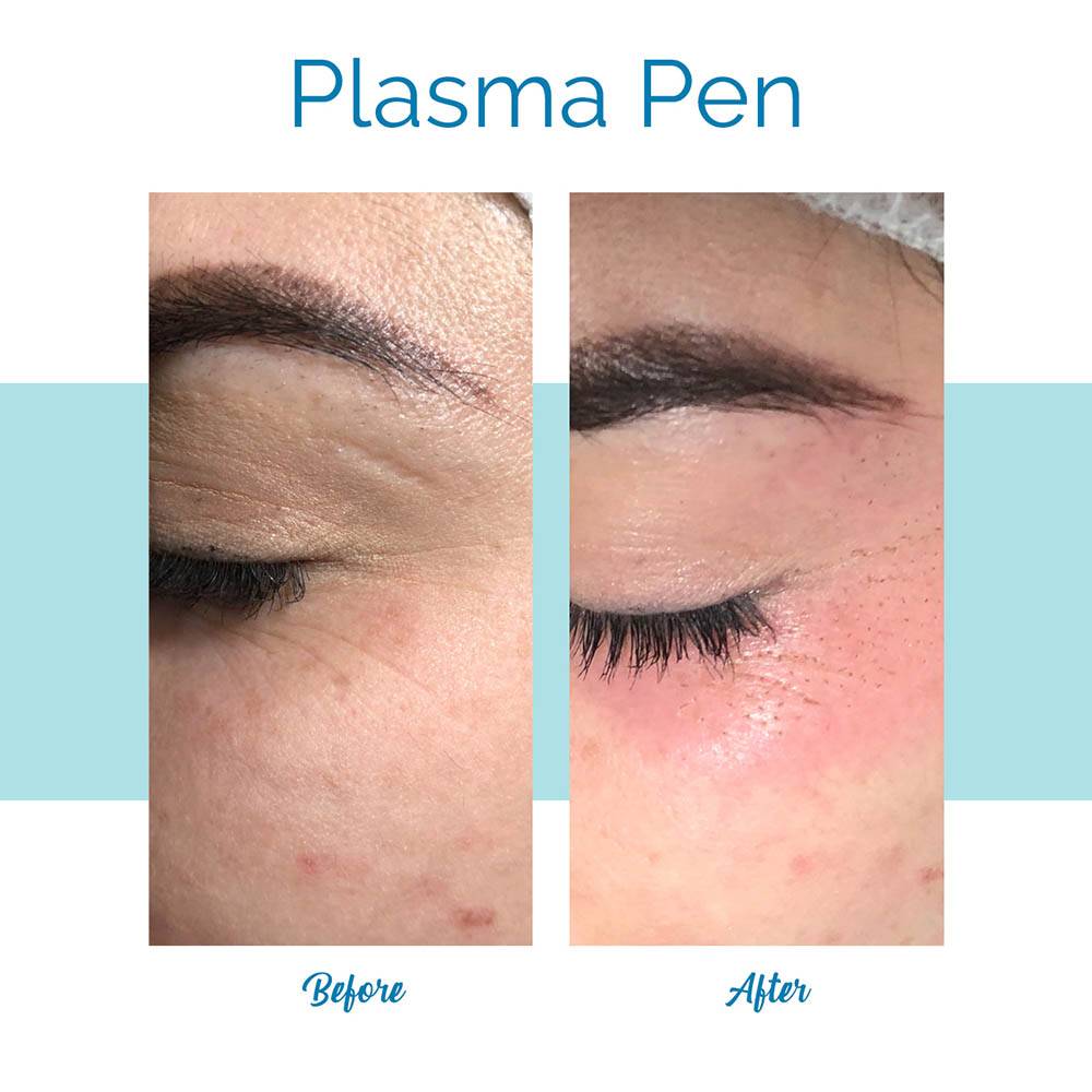 Bella Medspa is the best Plasma Pen provider in Atlanta