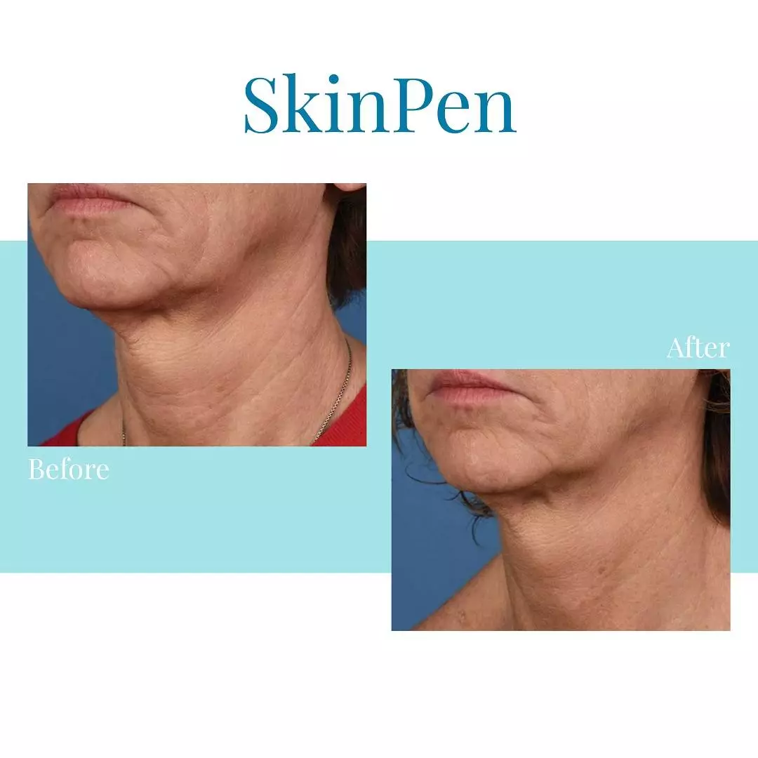 Bella Medspa is the best SkinPen microneedling provider of SkinPen