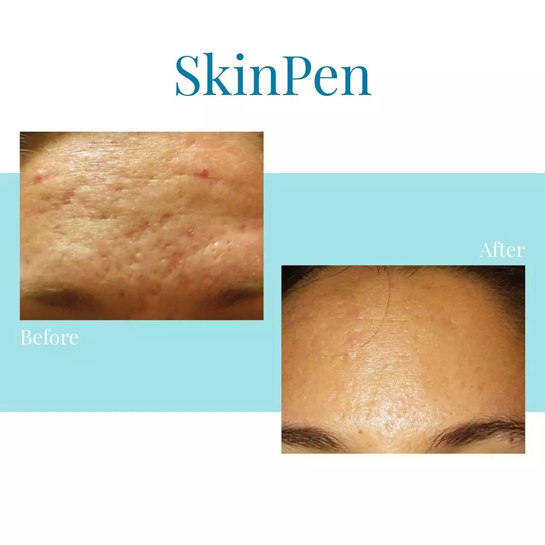 Bella Medspa is the best provider of SkinPen microneedling in Buckhead and Alpharetta