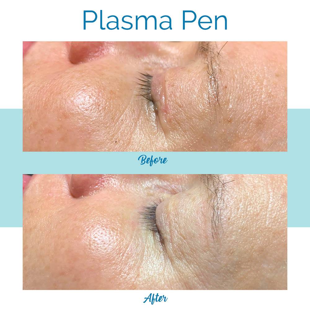 Bella Medspa is the leading Plasma Pen provider in Buckhead and Alpharetta