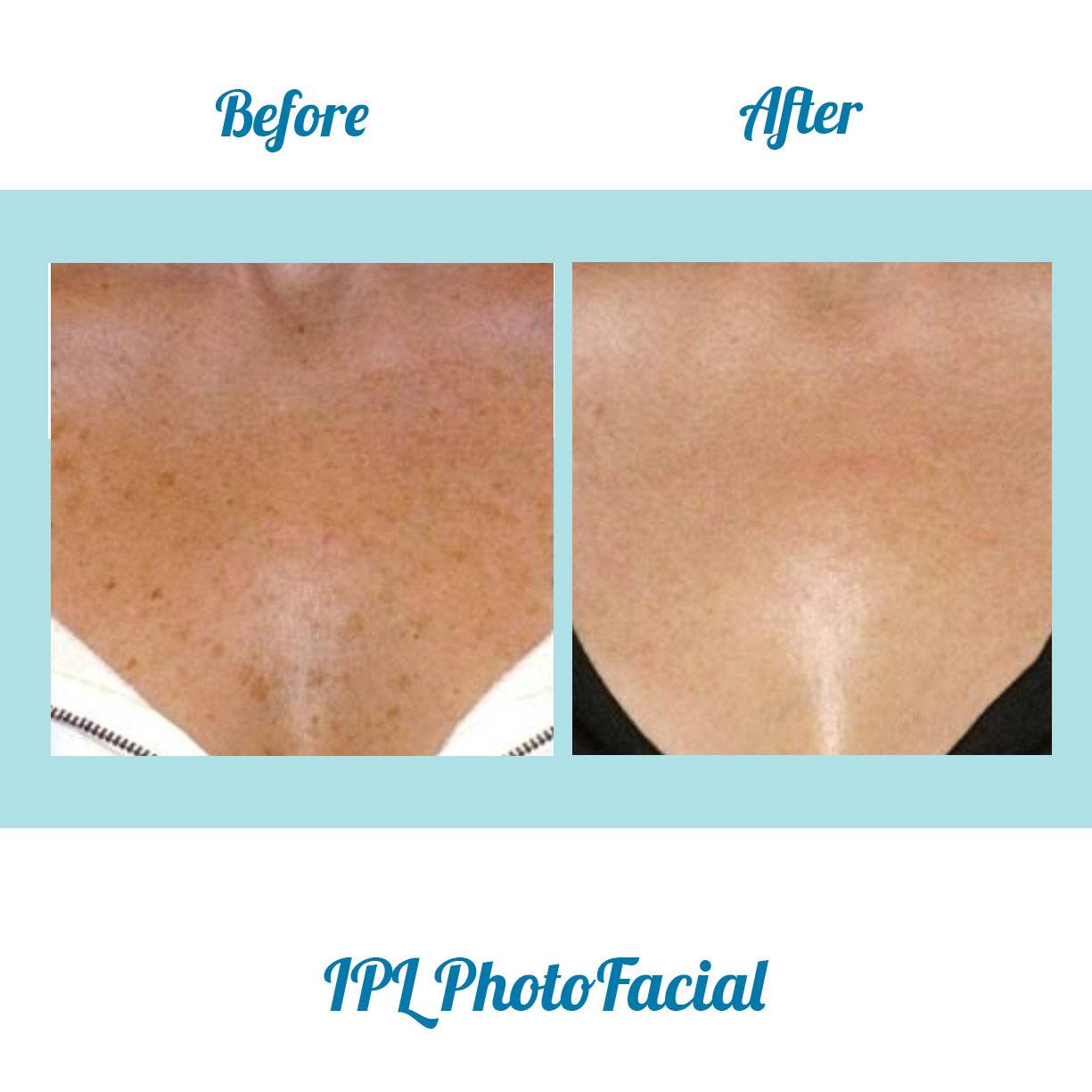 Bella Medspa is the leading provide of IPL Photofacials in Alpharetta