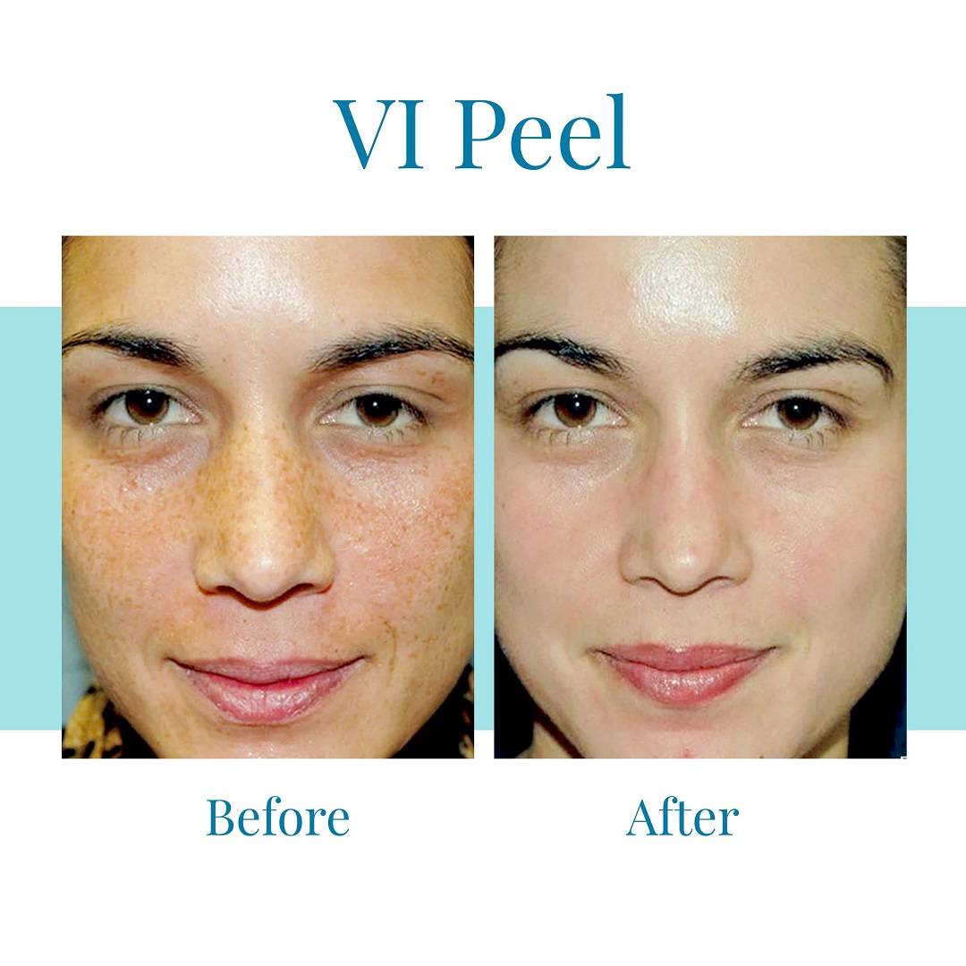 Bella Medspa is the leading provider of VI Peel in Alpharetta and Buckhead