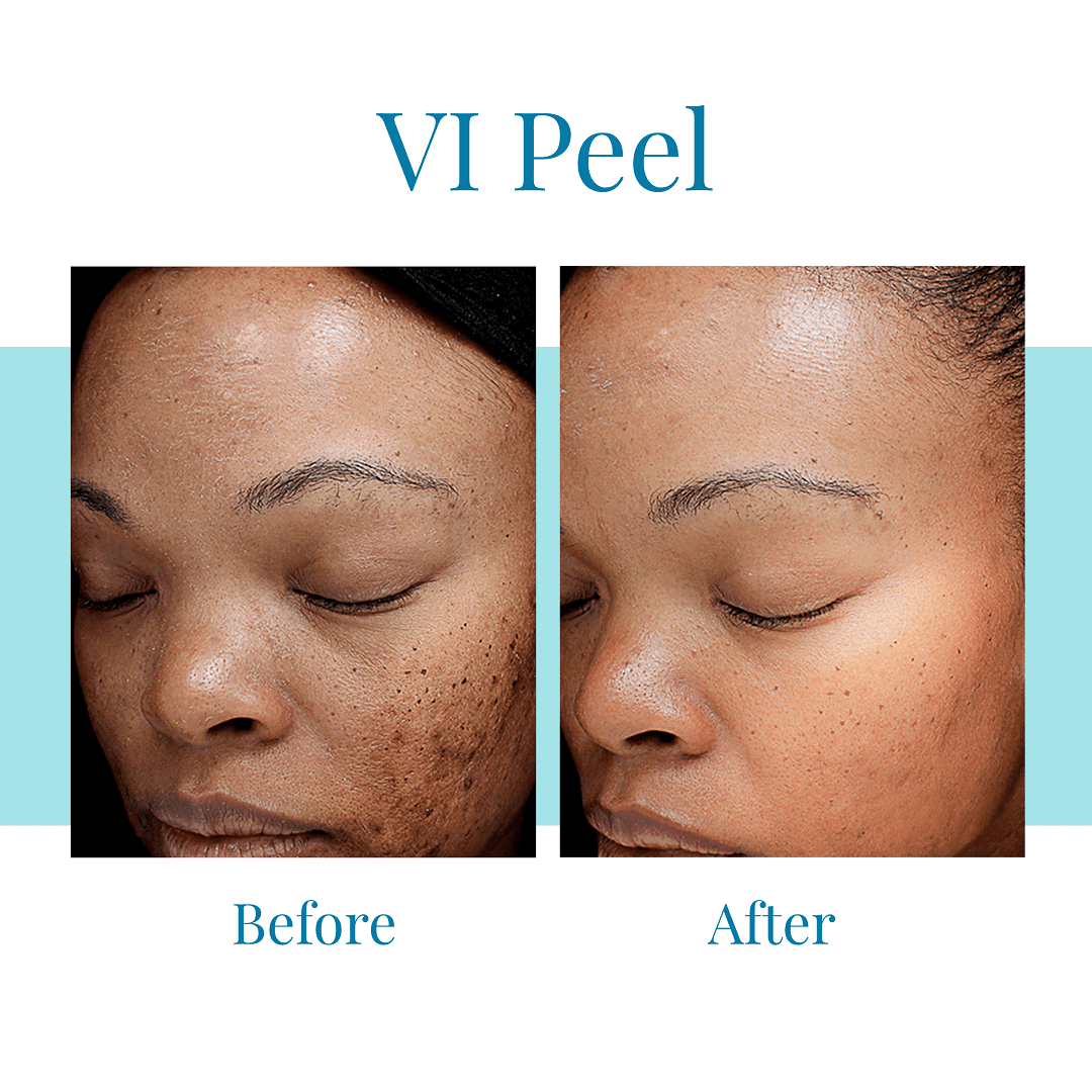 Bella Medspa is the leading provider of VI Peel in greater Atlanta