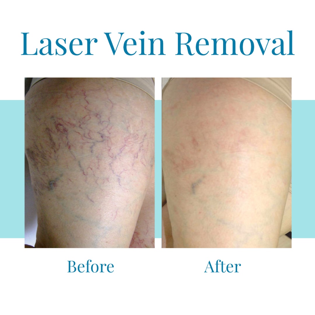 Bella Medspa is the leading provider of laser vein removal in Alpharetta and Buckhead