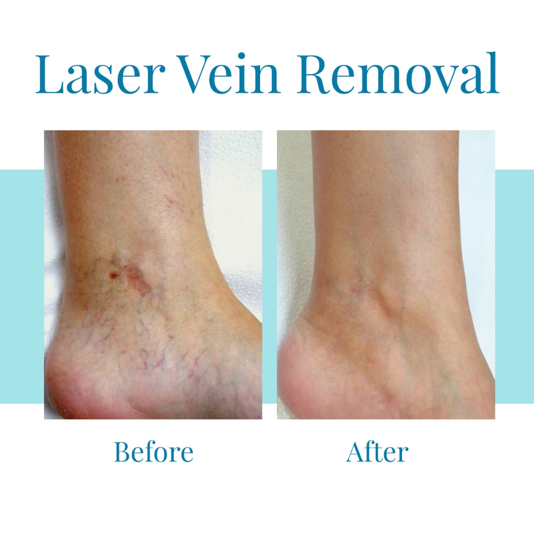 Bella Medspa is the leading provider of laser vein removal in Buckhead and Alpharetta