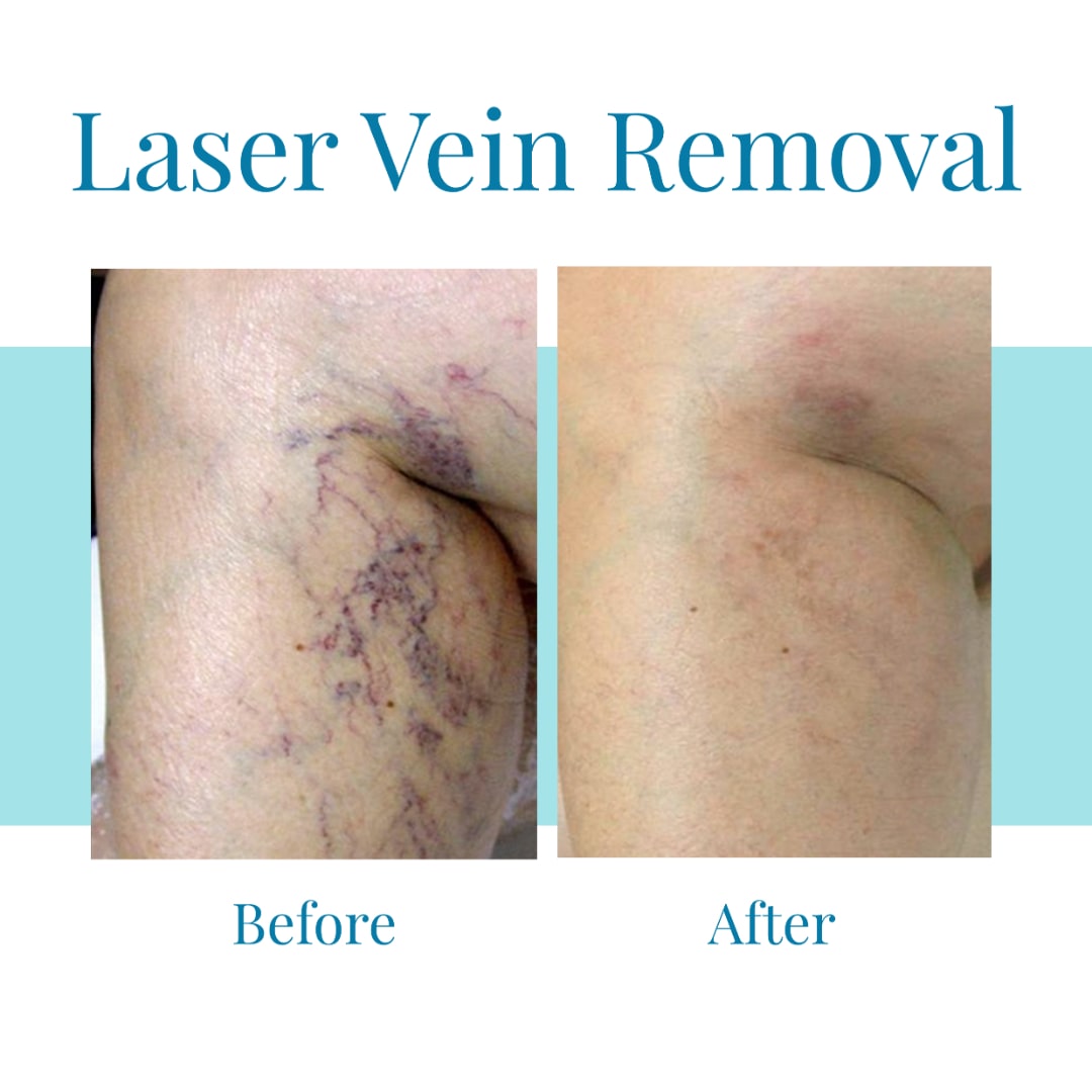 Bella Medspa is the leading provider of laser vein removal in greater Atlanta