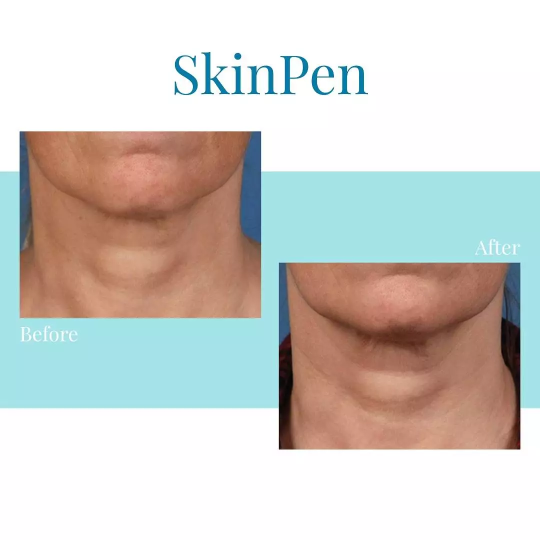 Bella Medspa is the top Buckhead and Alpharetta provider of SkinPen microneedling