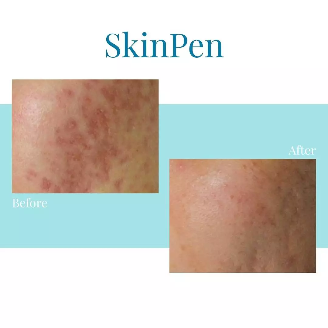 Bella Medspa is the top provider of SkinPen microneedling in Buckhead and Alpharetta