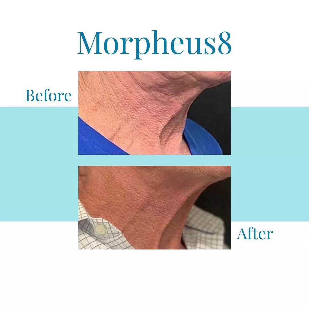 Bella Medspa offers Morpheus8 in Alpharetta