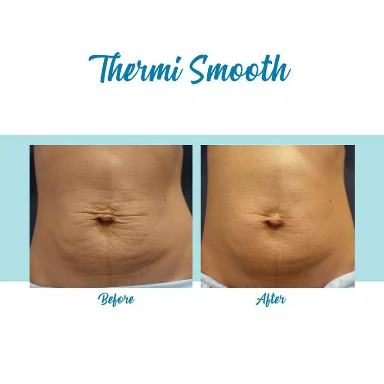 Bella Medspa offers ThermiSmooth Body in Alpharetta