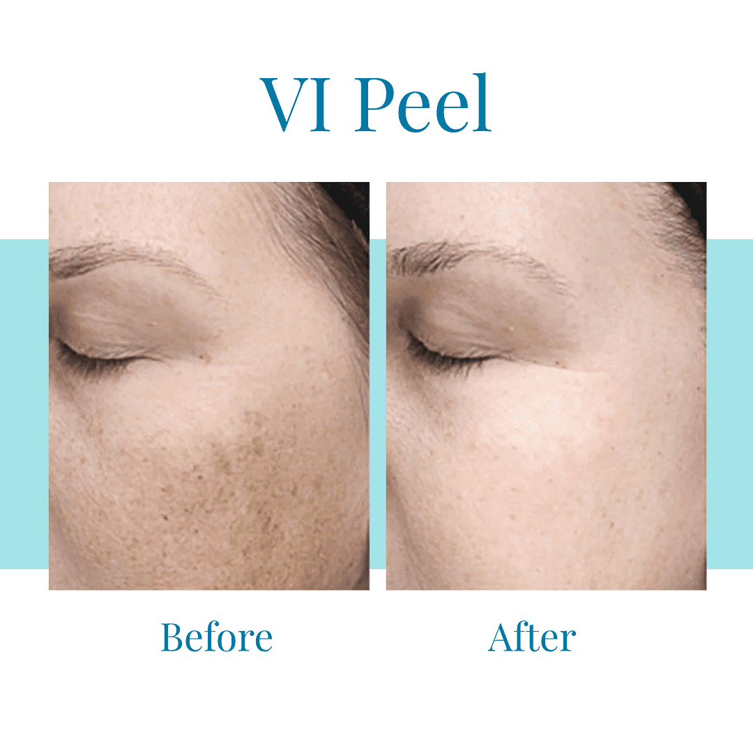 For a VI Peel in Buckhead and Alpharetta, trust Bella Medspa