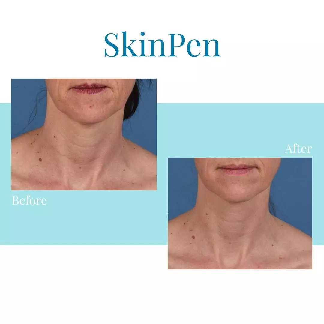 In Buckhead and Alpharetta, trust Bella Medspa for SkinPen microneedling