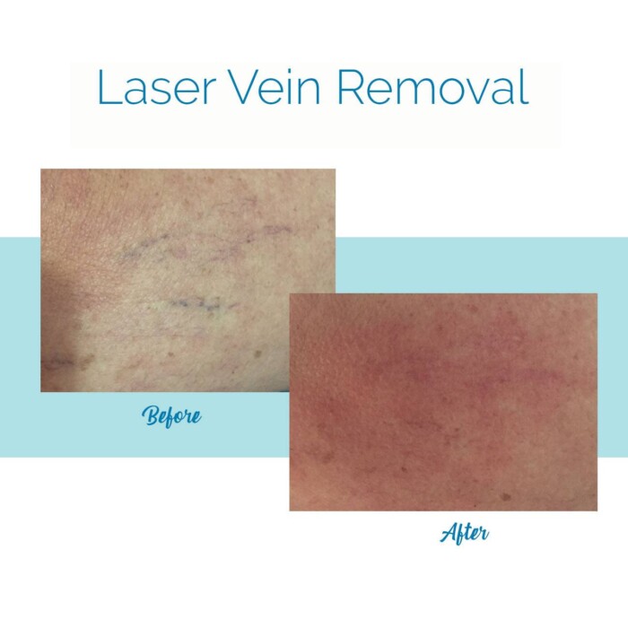 Laser Vein Removal