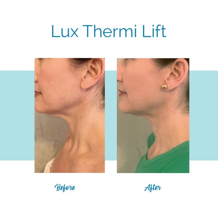 Bella's Lux Thermi Lift - Neck