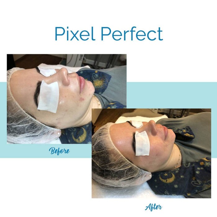 Pixel Perfect Laser Facial - Before & After