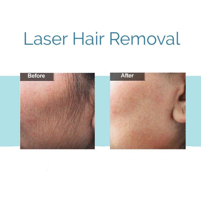 Laser Hair Removal