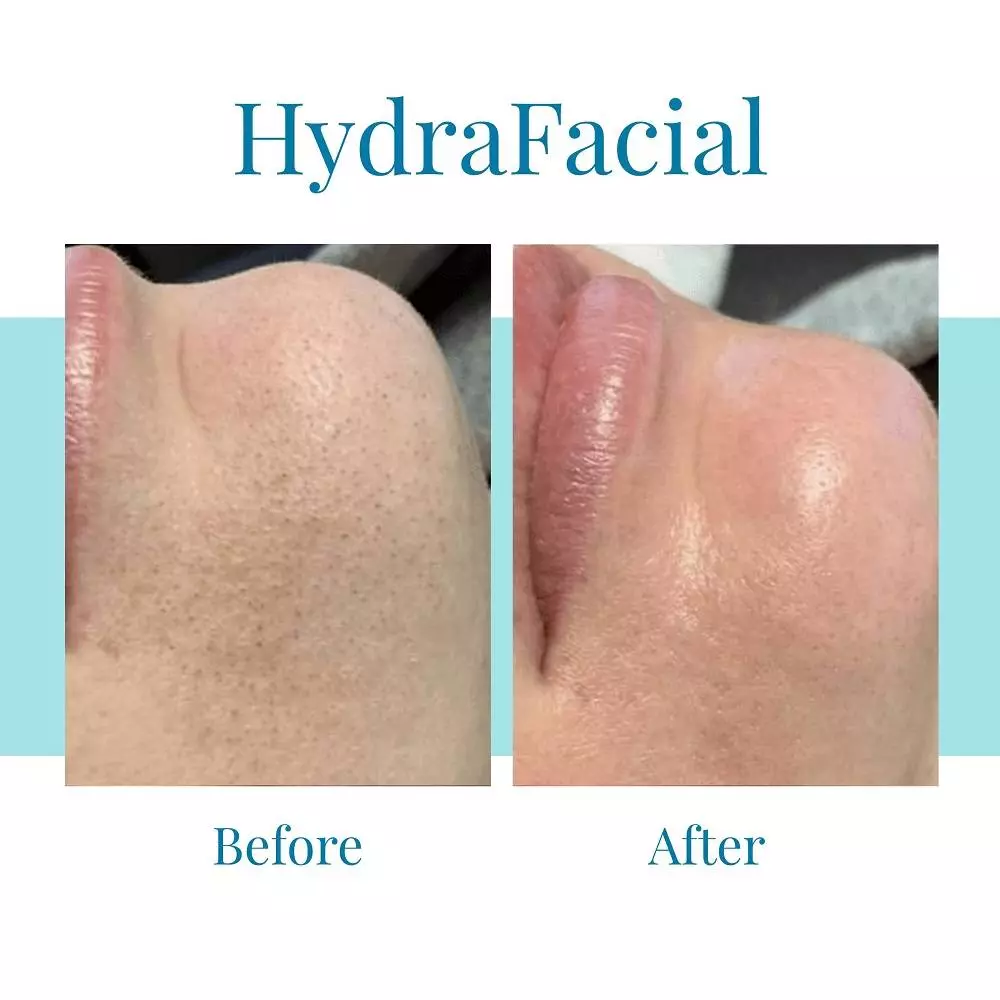 Hydrafacial is offered in Atlanta, Buckhead, and Alpharetta by Bella Medspa