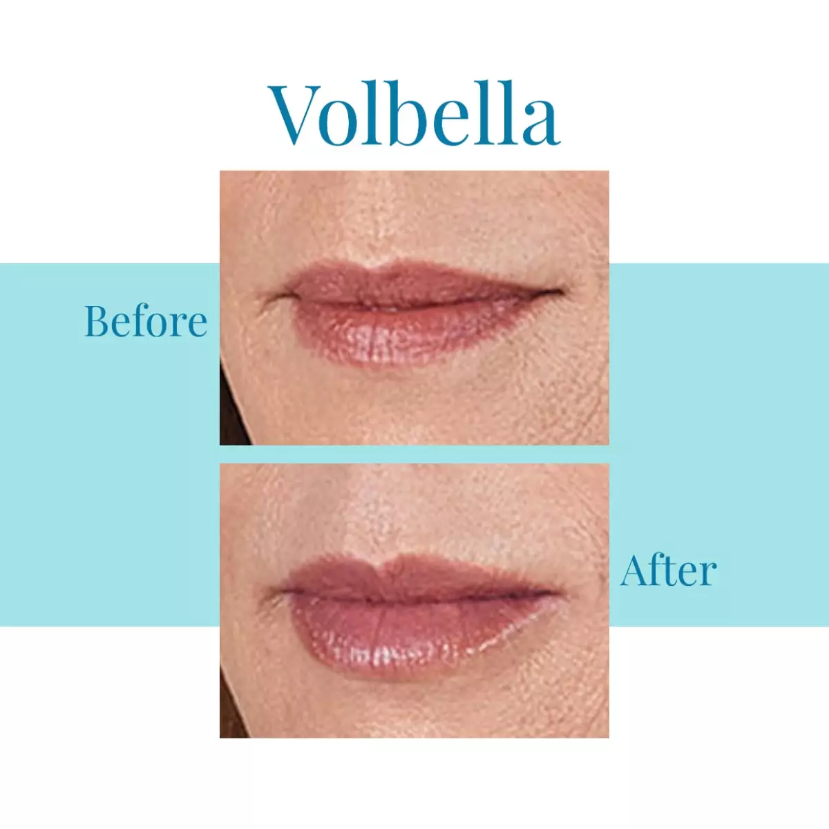 Bella-Medspa-is-the-leading-provider-of-Juvederm-Volbella-in-Alpharetta-and-Buckhead