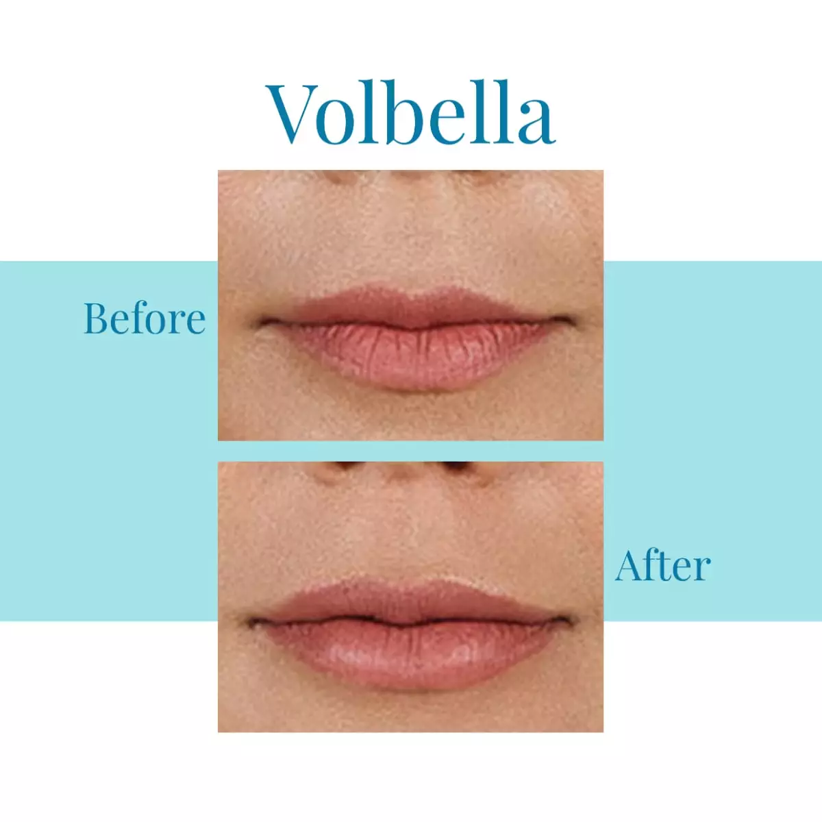 Bella-Medspa-is-the-leading-provider-of-Juvederm-Volbella-in-Buckhead-and-Alpharetta