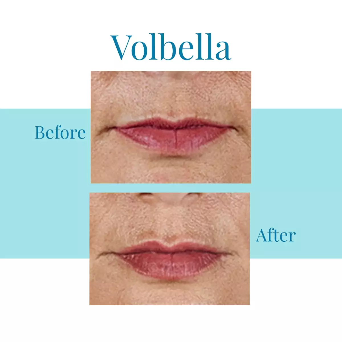 Bella-Medspa-is-the-leading-provider-of-Juvederm-Volbella-in-greater-Atlanta