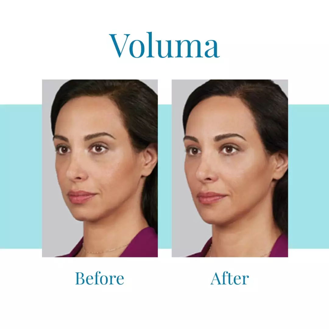 Bella-Medspa-is-the-leading-provider-of-Juvederm-Voluma-in-Alpharetta-and-Buckhead