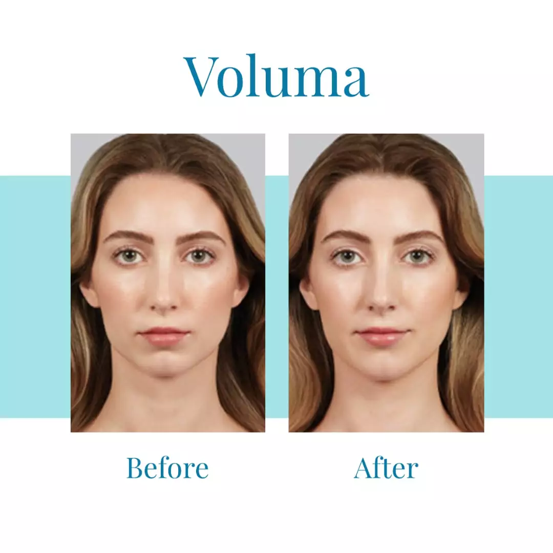 Bella-Medspa-is-the-leading-provider-of-Juvederm-Voluma-in-Buckhead-and-Alpharetta