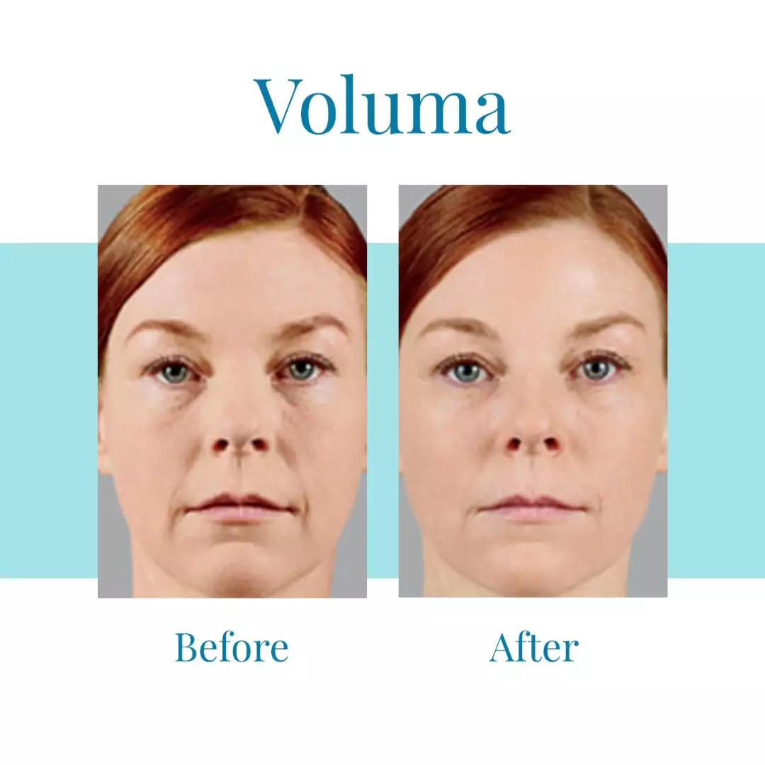 Bella-Medspa-is-the-leading-provider-of-Juvederm-Voluma-in-greater-Atlanta