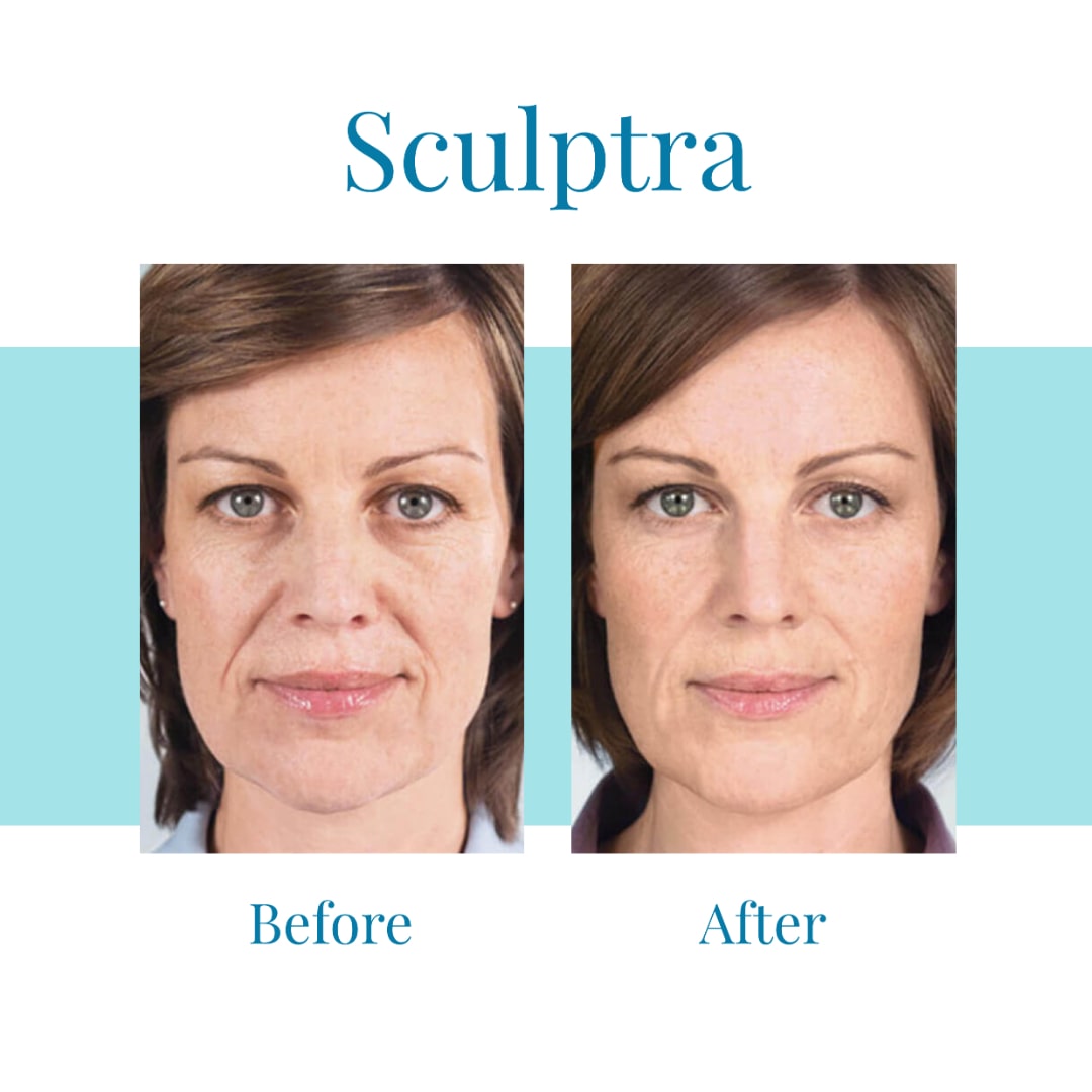 Bella-Medspa-is-the-leading-provider-of-Sculptra-in-greater-Atlanta